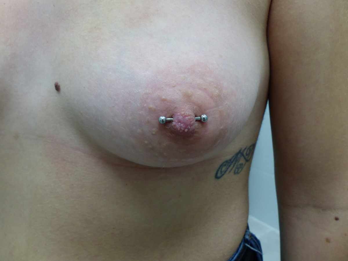 pezon plano piercing reparador